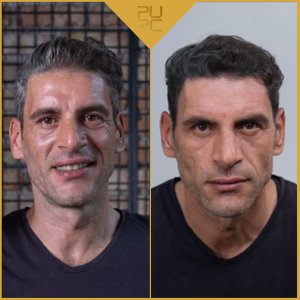 After 2 weeks of use